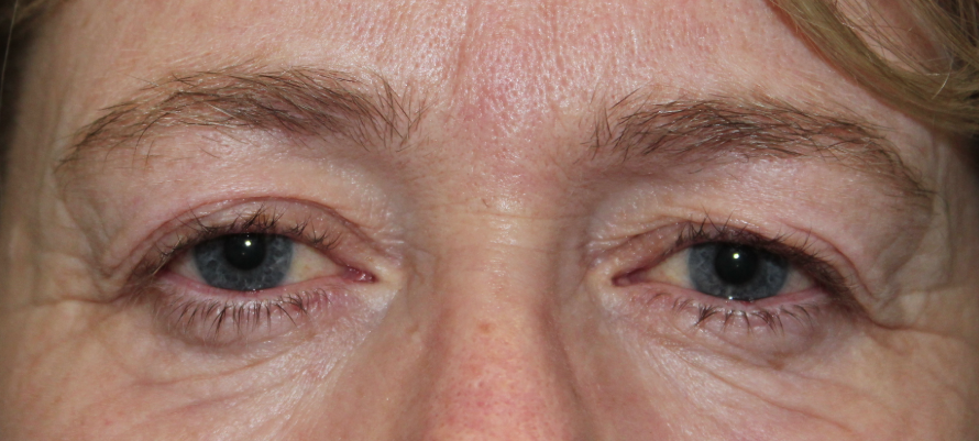 Bilateral Upper Eyelid Blepharoplasty (Postoperative Month 2) Before