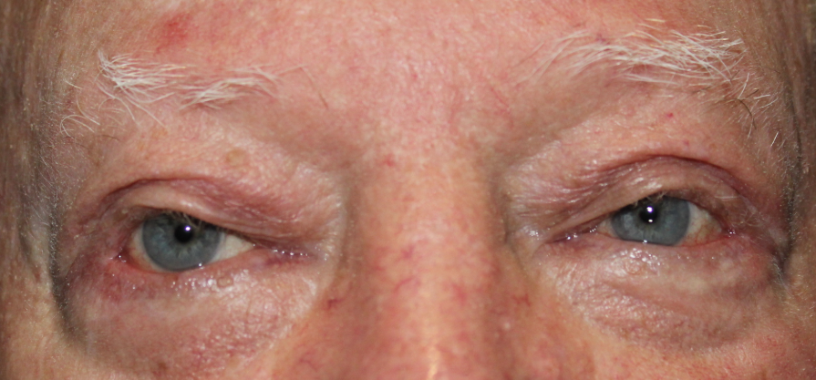 BUL External Ptosis and BLL Ectropion Repair (Post-Operative Month 1) After