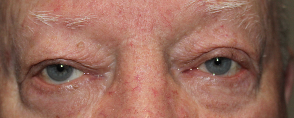 BUL External Ptosis and BLL Ectropion Repair (Post-Operative Month 1) Before