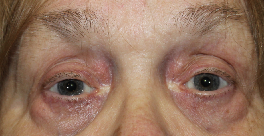 RUL External Ptosis Repair (Post-Operative Month 2) After