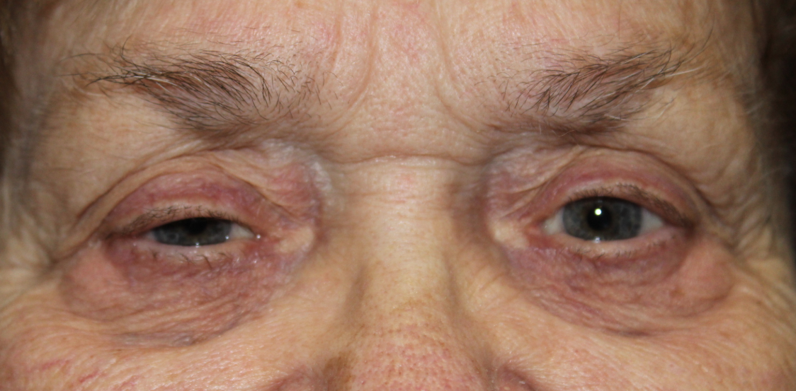 RUL External Ptosis Repair (Post-Operative Month 2) Before