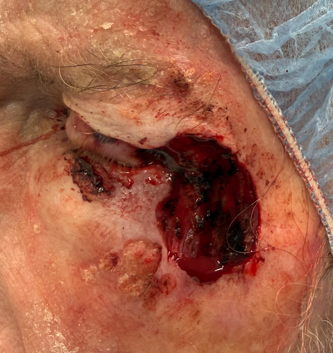 Basal Cell Carcinoma on the Left Lower Eyelid (POM2) After Surgery