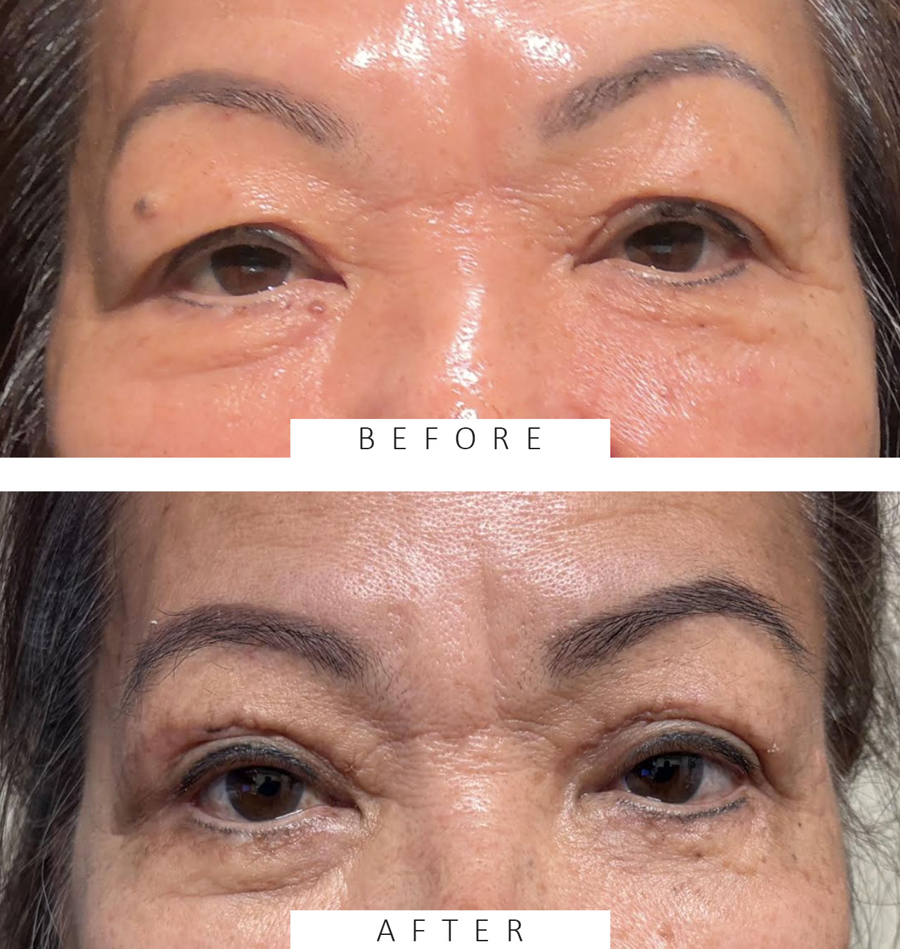 Ptosis Repair BUL & Blepharoplasty