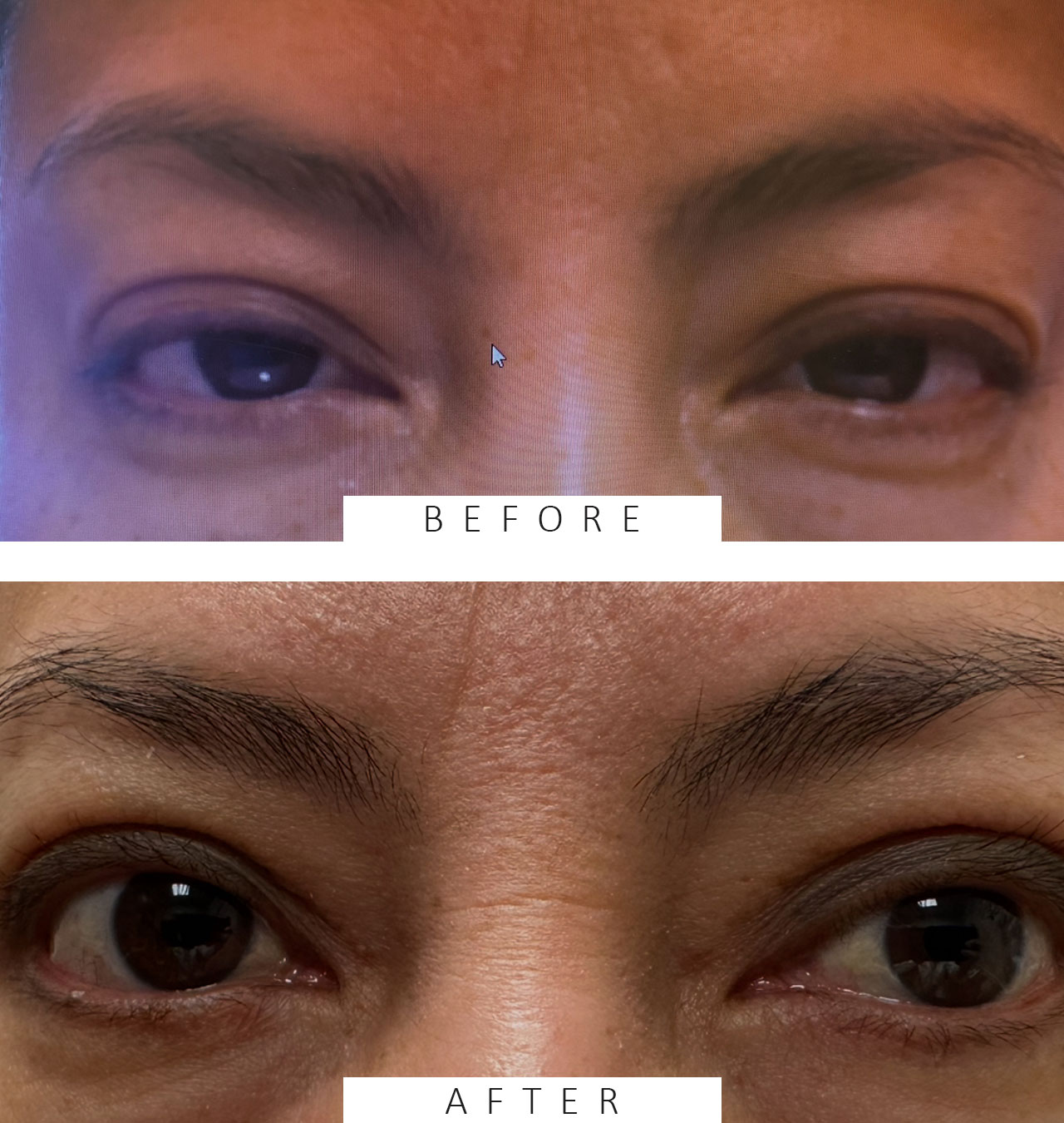 Ptosis Repair Blepharoplasty both Upper Lids