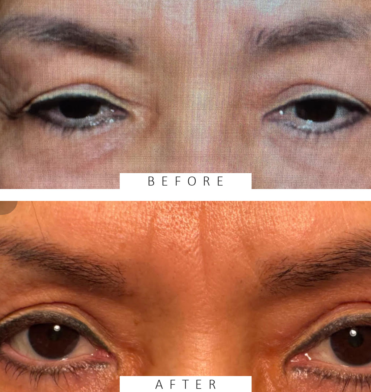 Ptosis Repair and Browpexy
