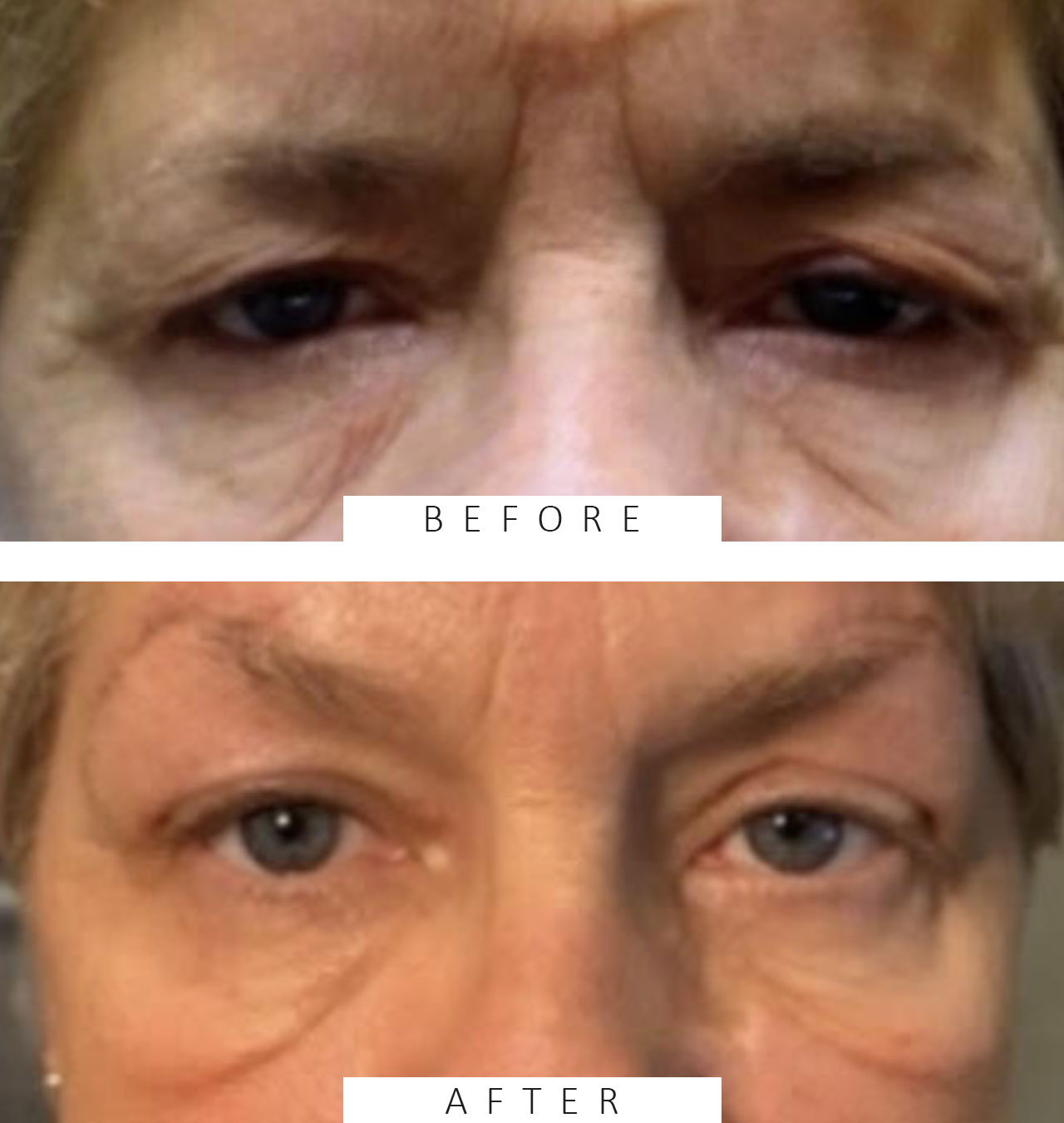 Lid Ptosis & Brow Ptosis Surgery