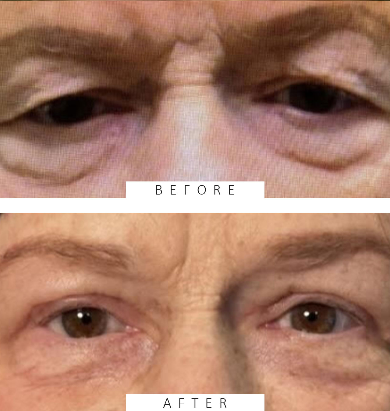 Lid Ptosis & Brow Ptosis Surgery
