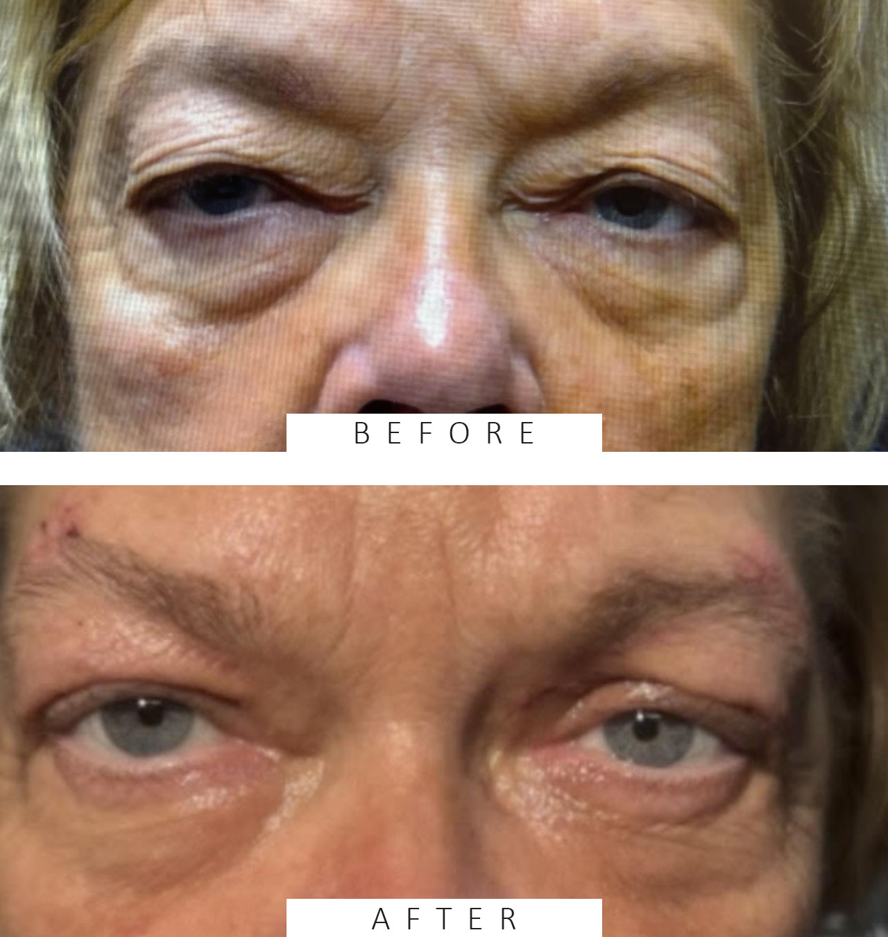 Lid Ptosis & Brow Ptosis Surgery