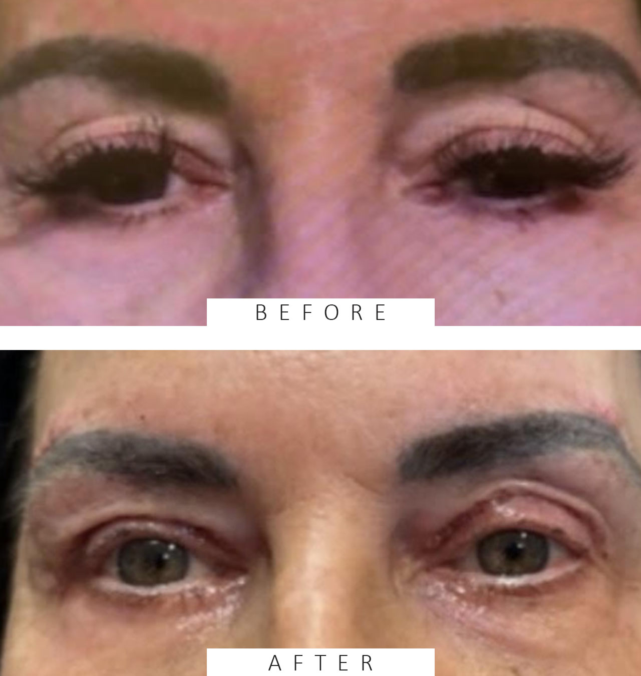Lid Ptosis & Brow Ptosis Surgery