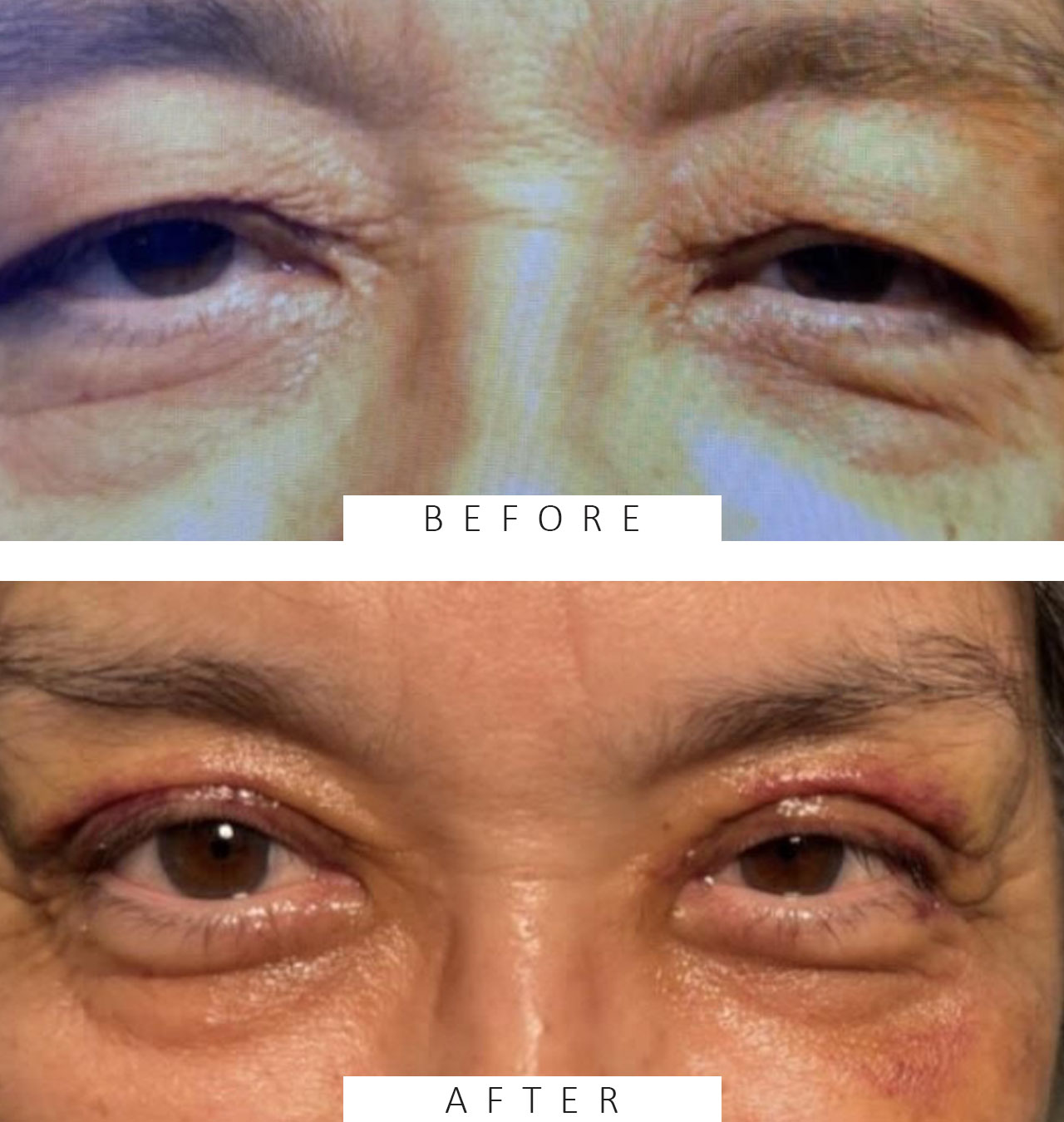 Lid Ptosis & Brow Ptosis Surgery