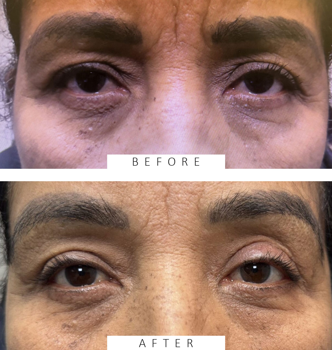 Lid Ptosis & Brow Ptosis Surgery