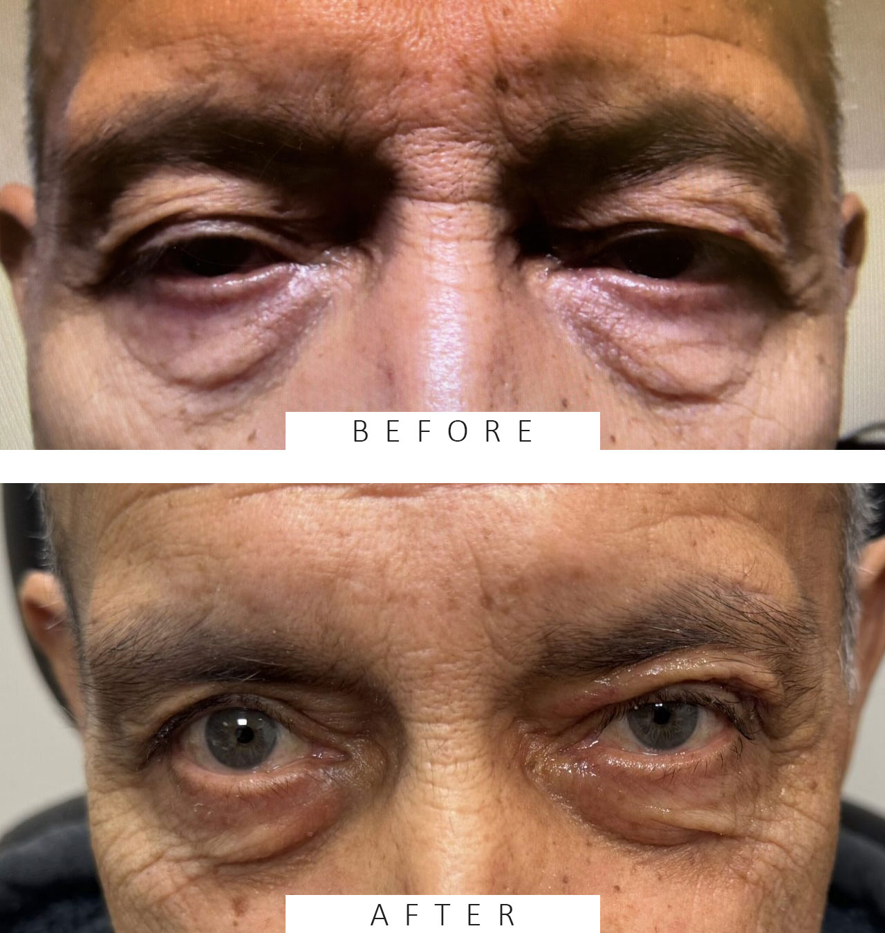 Lid Ptosis & Brow Ptosis Surgery