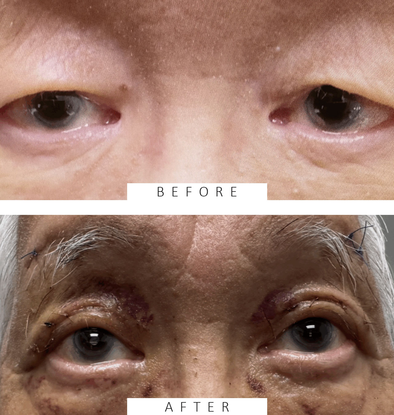 Asian Blepharoplasty (Westernization )