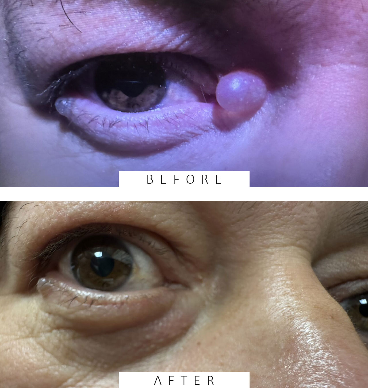 Excision of Lesion Nasal