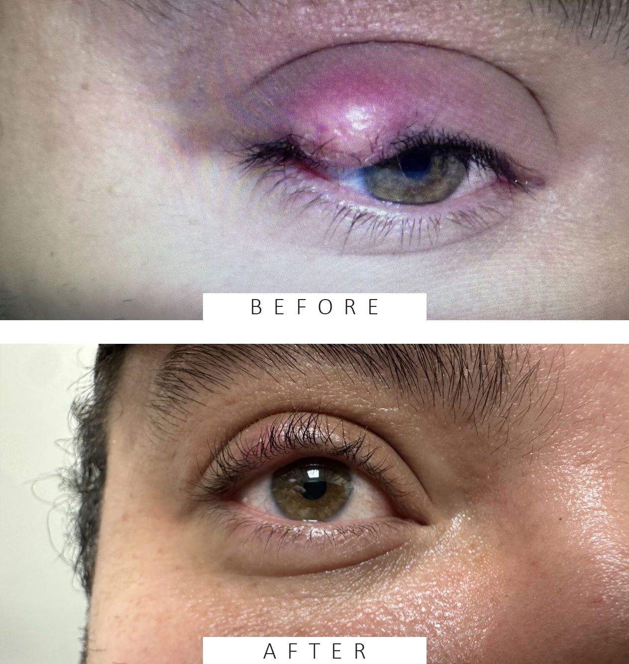 Excision of Lesion Eye