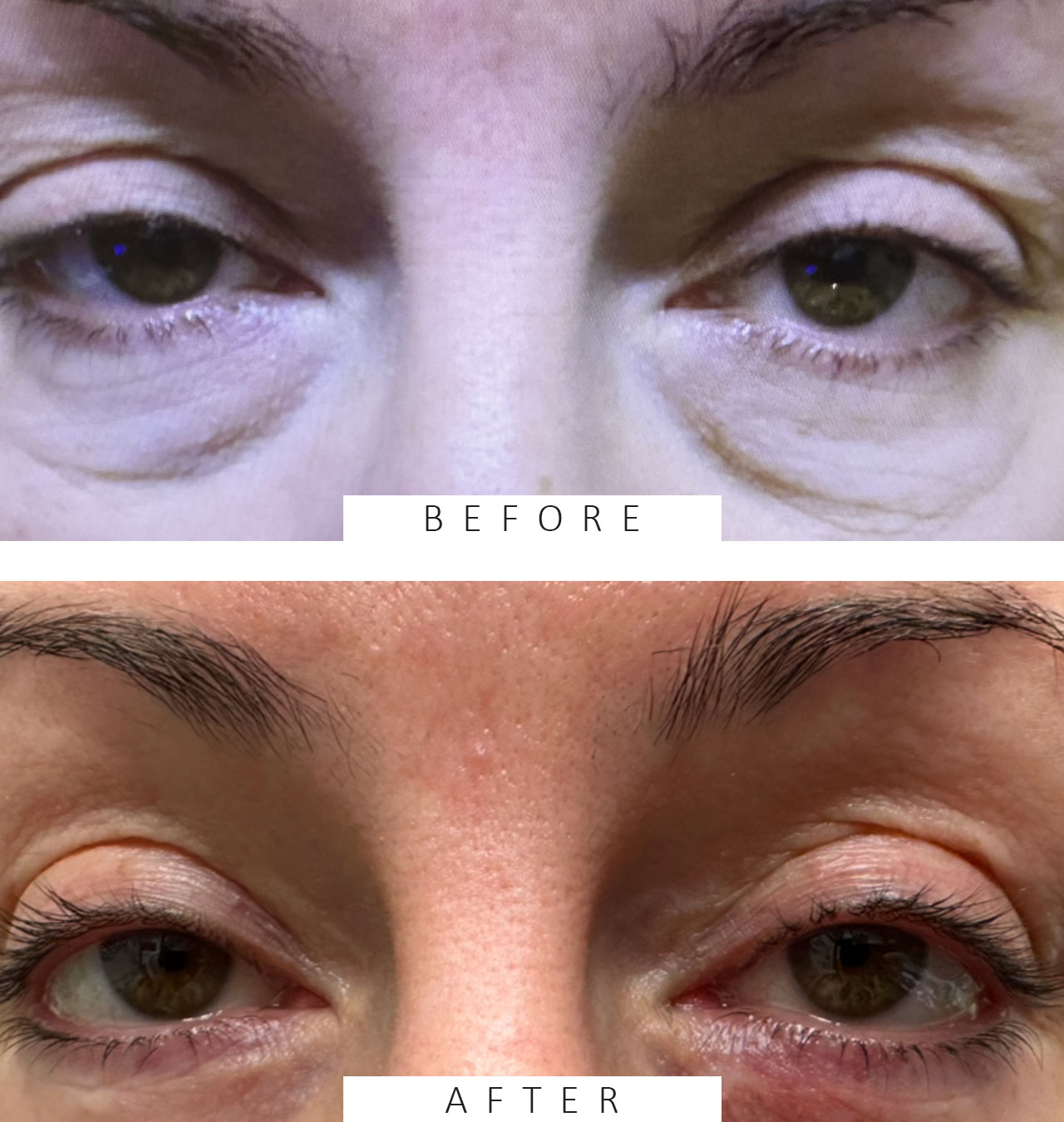 Upper and Lower Eyelid Cosmetic Blepharoplasty and Brow Lift Both Eyes
