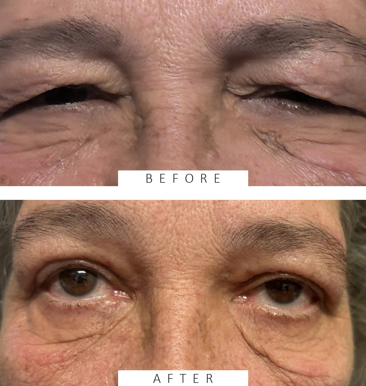 Ptosis Repair
