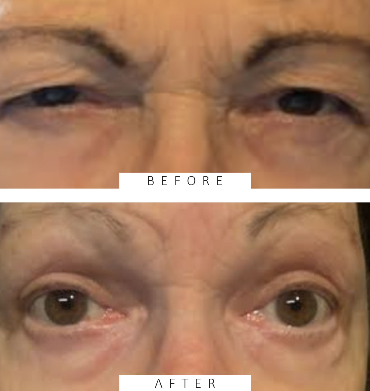 Post Ptosis Repair w/ Levator Advancement, w/ Direct Temporal Brow Lift