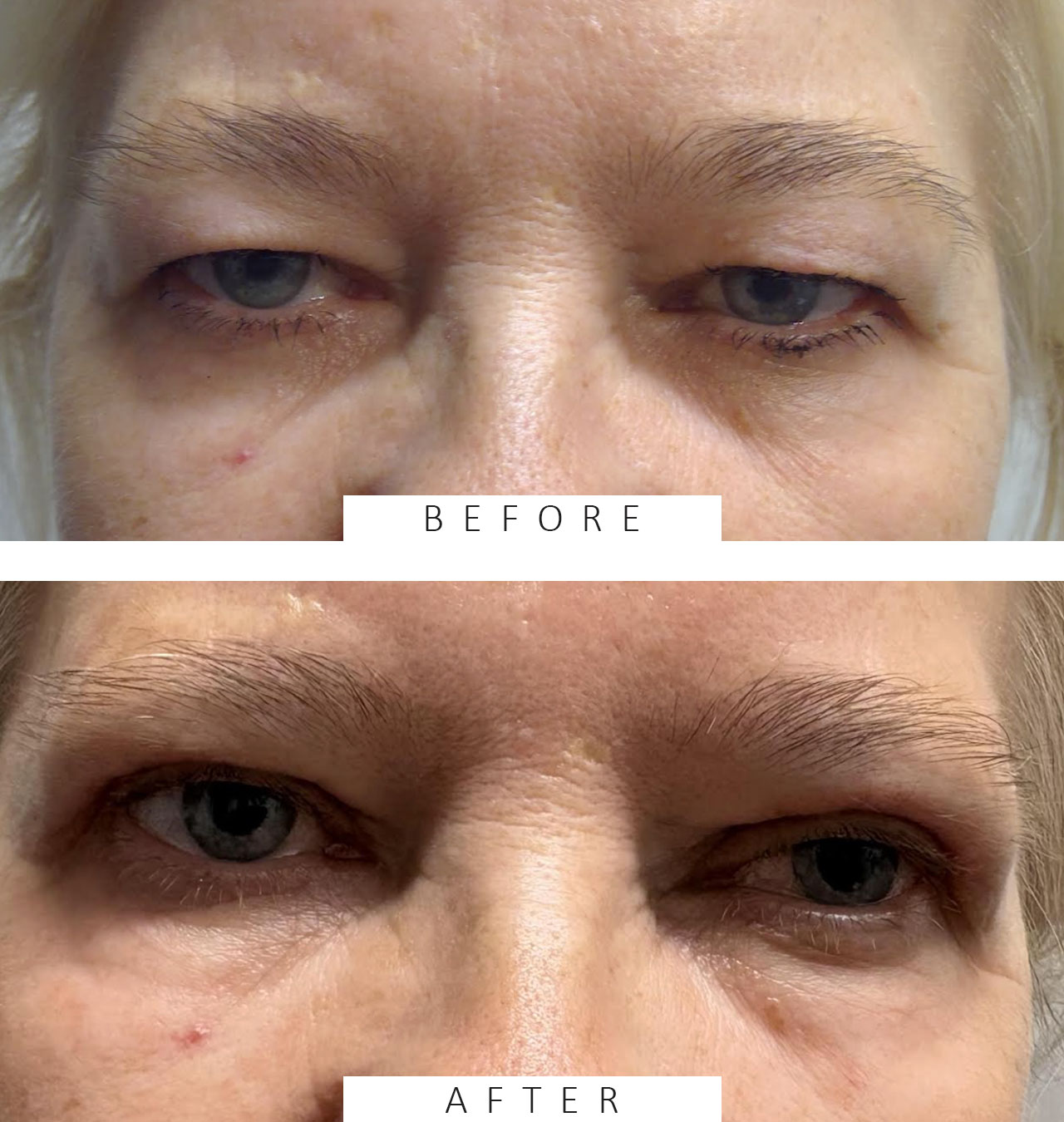 Ptosis Repaid