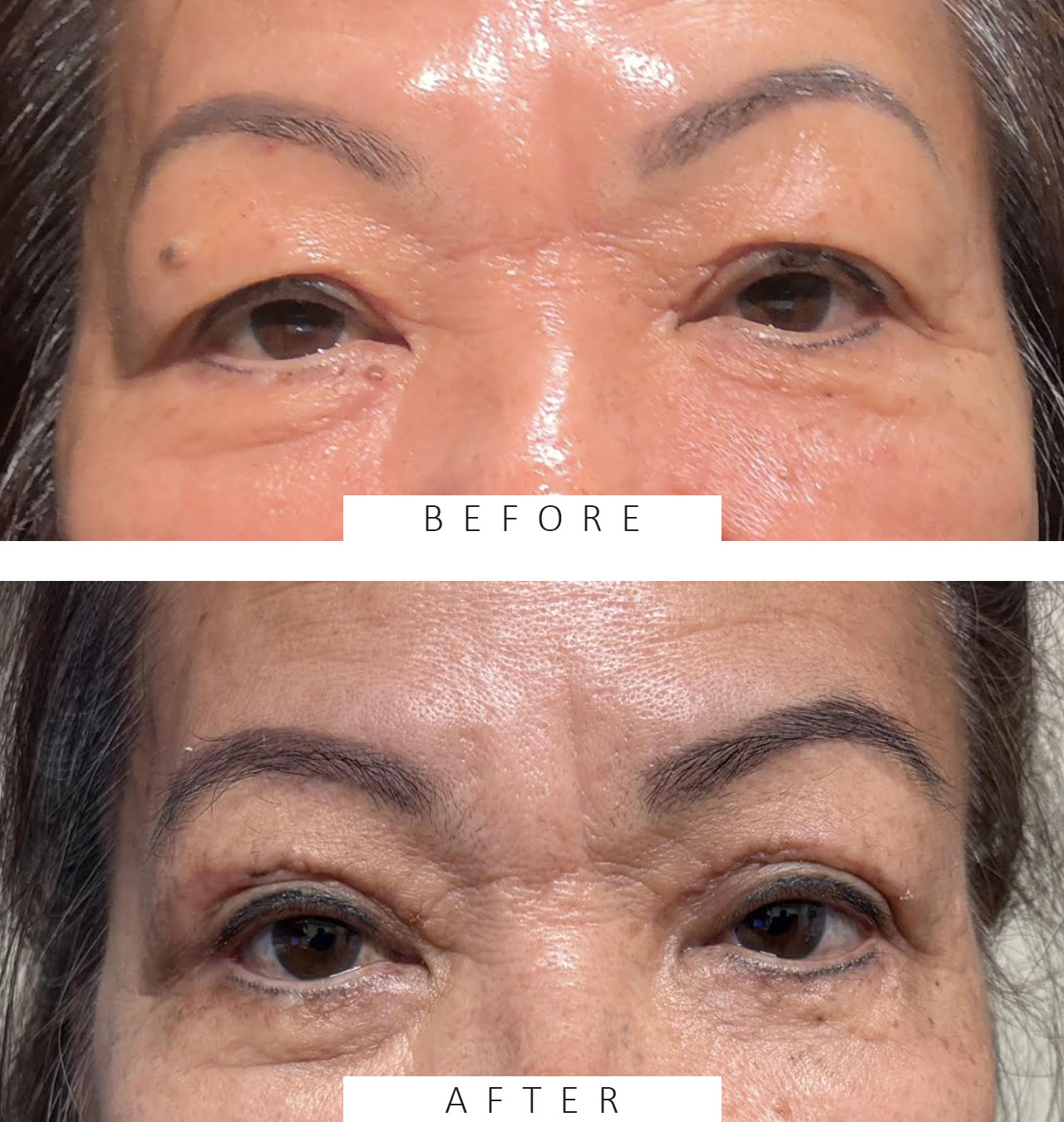 Ptosis Repair BUL & Blepharoplasty