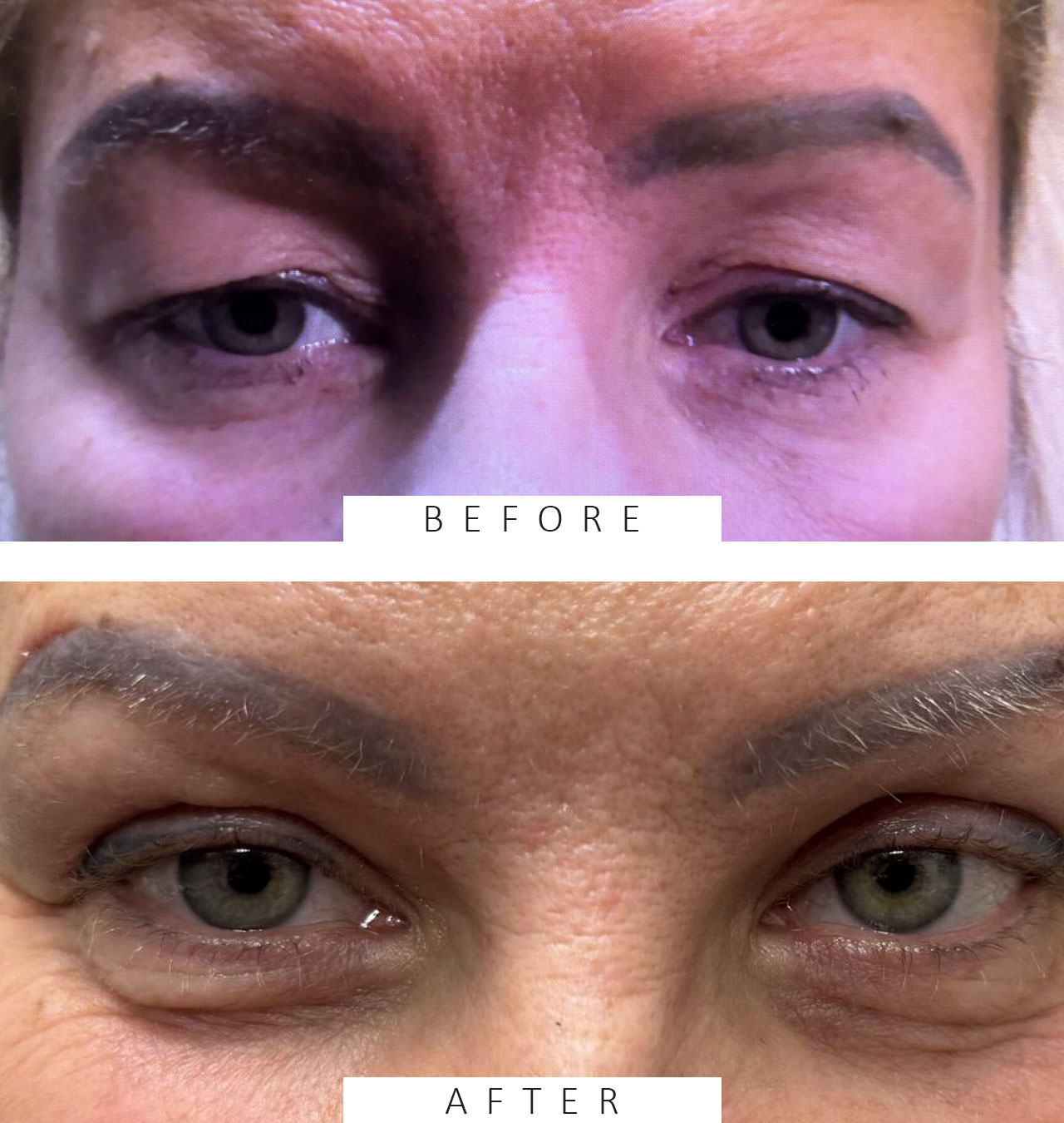 Ptosis & Brow Repair