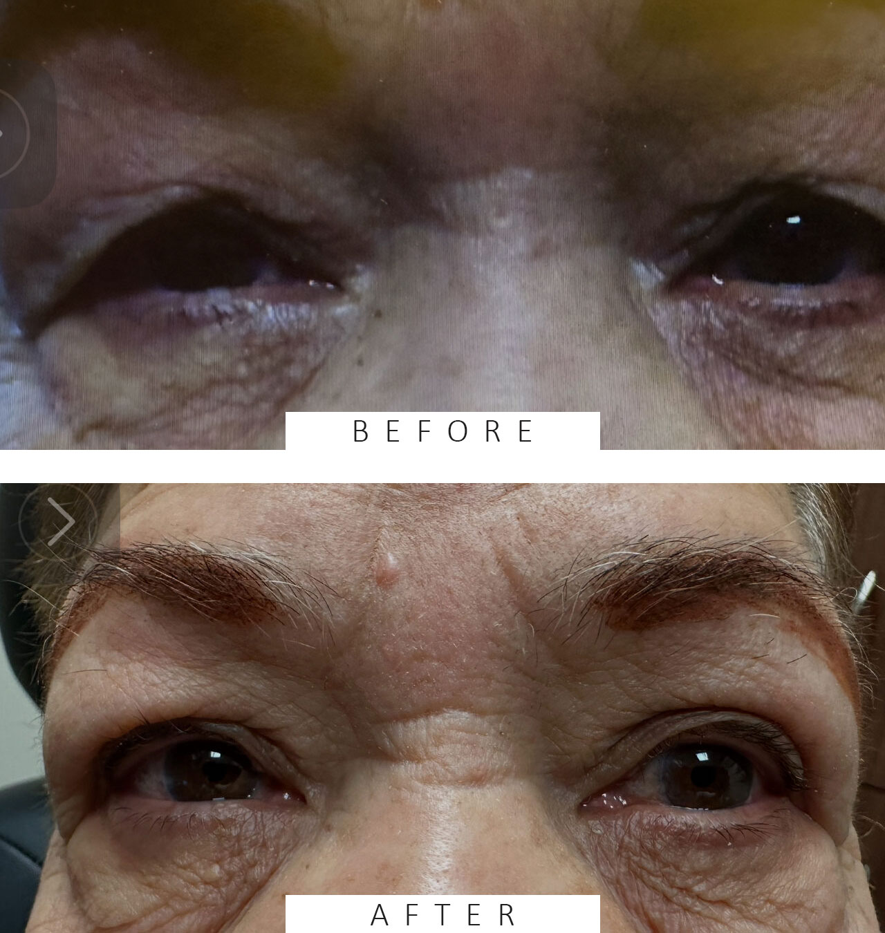 Ptosis repair for both the right and left upper eyelids, along with Upper Blepharoplasty for the eyelids on both sides, and Browpexy/Brow lift on the right and left brows