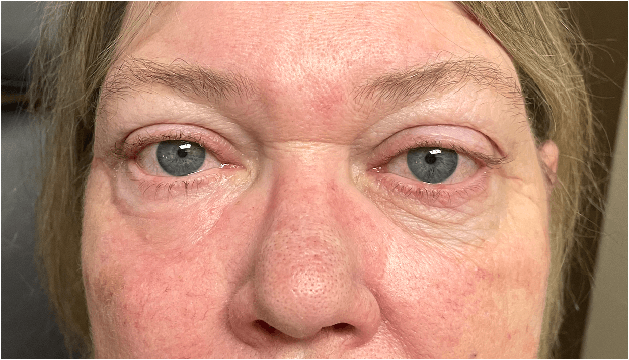 Eyelid Reconstruction After Skin Cancer 4 Months After Reconstruction