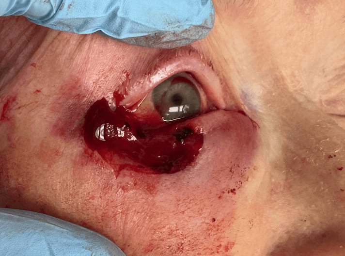 Reconstruction for squamous cell carcinoma post op image.