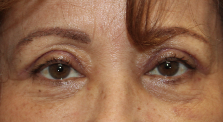 Bilateral Upper Eyelid Ptosis Repair (Postoperative Week 2) After