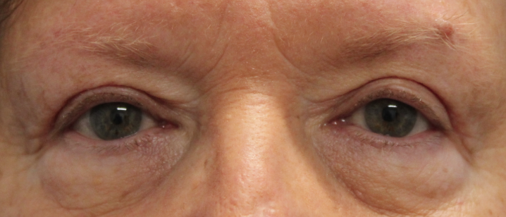 Bilateral Upper Eyelid Ptosis Repair (Postoperative Month 3) After