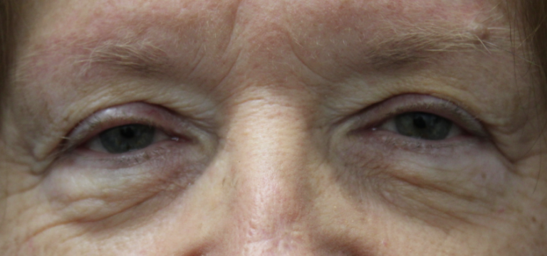 Bilateral Upper Eyelid Ptosis Repair (Postoperative Month 3) Before