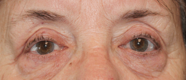 Bilateral Upper Eyelid External Ptosis Repair (Post-Operative Month 3) After
