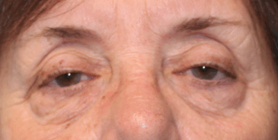 Bilateral Upper Eyelid External Ptosis Repair (Post-Operative Month 3) Before