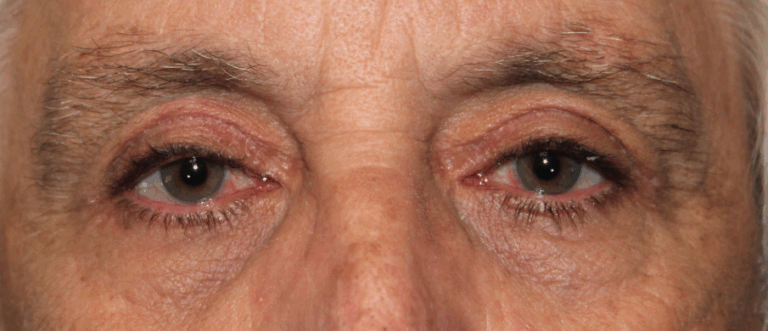 Bilateral Upper Eyelid External Ptosis Repair (Post-Operative Week 1) After