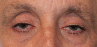Bilateral Upper Eyelid External Ptosis Repair (Post-Operative Week 1) Before