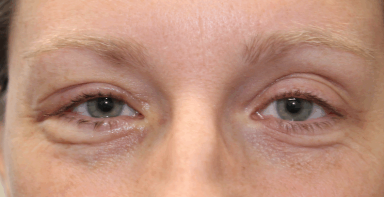 Right Upper Eyelid Internal Ptosis Repair (Post-Operative Week 1) After