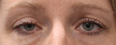 Right Upper Eyelid Internal Ptosis Repair (Post-Operative Week 1) Before