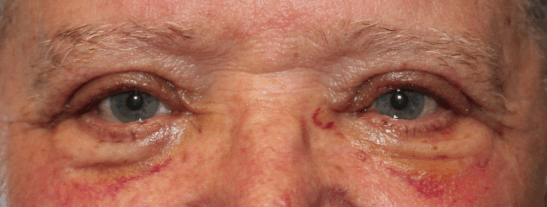 Bilateral Upper Eyelid External Ptosis Repair (Post-Operative Week 1) After