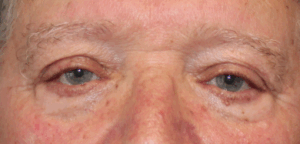 Bilateral Upper Eyelid External Ptosis Repair (Post-Operative Week 1) Before