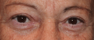 Bilateral Upper Eyelid External Ptosis Repair After