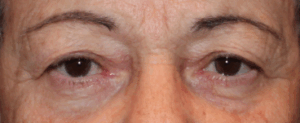 Bilateral Upper Eyelid External Ptosis Repair Before