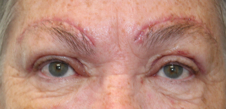 Bilateral Upper Eyelid External Ptosis Repair & Bilateral Direct Brow Lift (Post-Operative Week 1) After