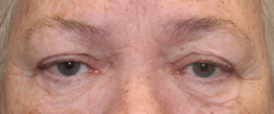 Bilateral Upper Eyelid External Ptosis Repair & Bilateral Direct Brow Lift (Post-Operative Week 1) Before
