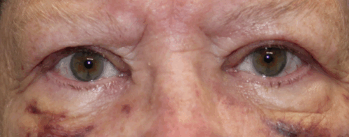 Bilateral Upper Eyelid External Ptosis Repair (Post-Operative Week 1) After
