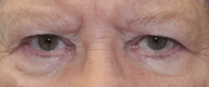Bilateral Upper Eyelid External Ptosis Repair (Post-Operative Week 1) Before