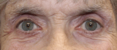Bilateral Upper Eyelid External Ptosis Repair (Post-Operative Month 3) After