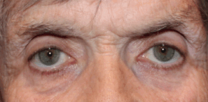 Bilateral Upper Eyelid External Ptosis Repair (Post-Operative Month 3) Before