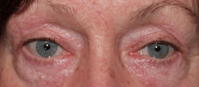 Bilateral Upper Eyelid External Ptosis Repair After