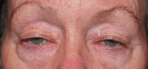 Bilateral Upper Eyelid External Ptosis Repair Before
