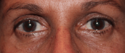 Left Upper Eyelid Internal Ptosis (Post-Operative Week 2) After